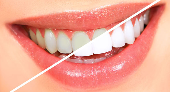 lasersko beljenje zuba u stomatoloskoj ordinaciji beograd