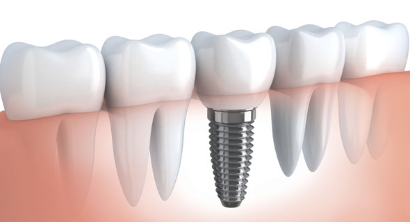 ugradnja implantata kod zubara